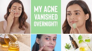 How To Make Your Acne Disappear Overnight | 4 Home Remedies For Pimples