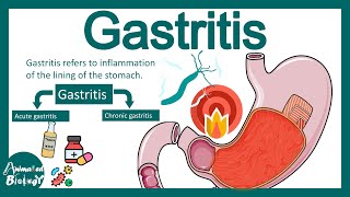 Gastritis | Pathology of gastritis | treatment of gastritis | USMLE step 1