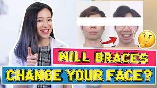Will Braces Change Your FACE? | #BraceYourself​!🦷