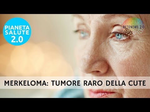 Merkeloma o carcinoma a cellule di Merkel, tumore rarissimo della pelle