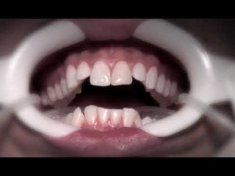 Comment utiliser la méthode indirecte pour la pose de vos boîtiers orthodontiques