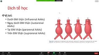 Ngoại bệnh lý 2 - Phình động mạch chủ bụng