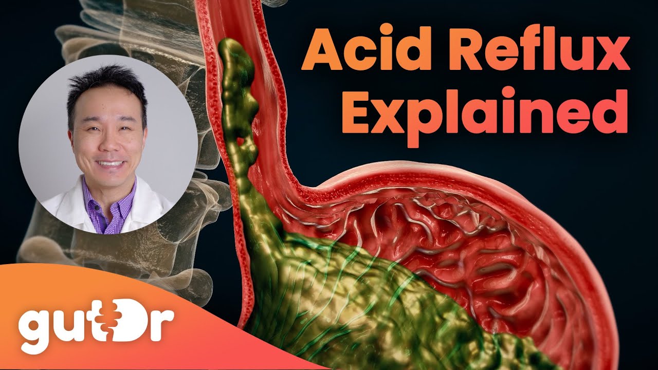 What Is Acid Reflux? | The GutDr Explains (3D Gut Animation)