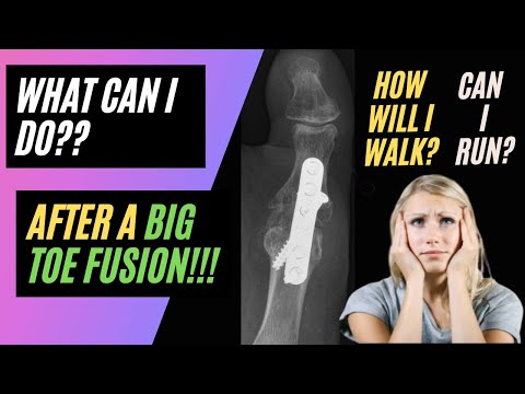 Was kann ich nach einer Großzehenversteifung tun? Laufen, Spazierengehen, Yoga?