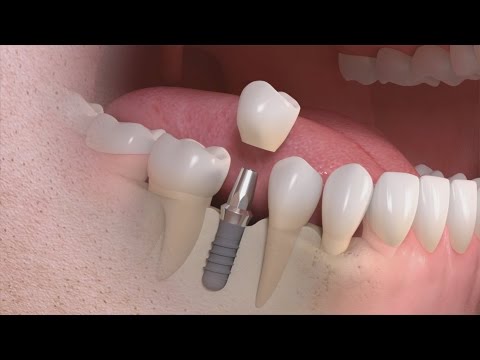 Straumann - Implantatgetragener Einzelzahnersatz