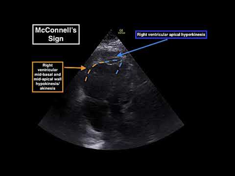 Point of Care Echocardiography of Massive Pulmonary Embolism Prior to Systemic Thrombolysis