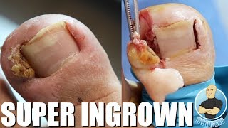 EXTREME INFECTED INGROWN TOENAIL REMOVAL ***WARNING GRAPHIC***