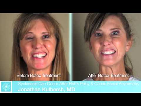Botox para la parálisis de Bell | El tratamiento de la parálisis de Bell Botox For Bell’s Palsy | Bell’s Palsy Treatment