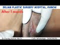 Designer Vegina Genital Cosmetic Surgery Labiaplasty Hymenoplasty Surgery In Ranchi
