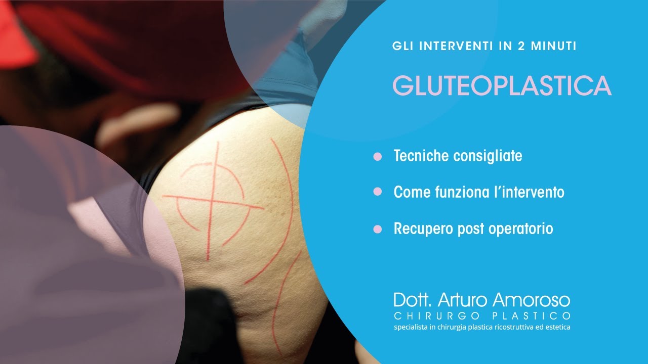 Gluteoplastica - Nuove tecniche, protesi e recupero.