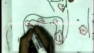 general pathology 30 : DR SAMEH GHAZY neoplasia2