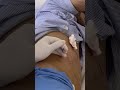 LIVER ABSCESS DRAIN || PERCUTANEOUS CATHETER DRAINAGE OF LIVER ABSCESS|| PIGTAIL CATHETER | Dr Raj