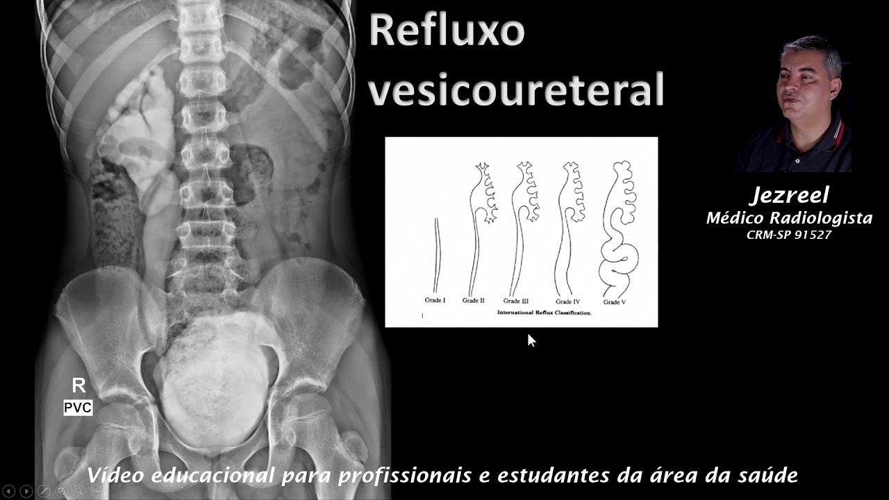 Refluxo vesico ureteral
