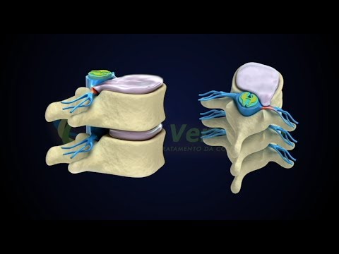 Rimedi popolari per la malattia degenerativa del disco delle recensioni cervicale della colonna vert Bruciore articolazioni che fanno