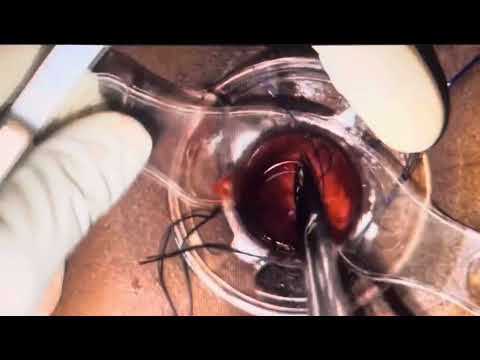 Laparoscopic Duodenojejunostomy for SMA Syndrome