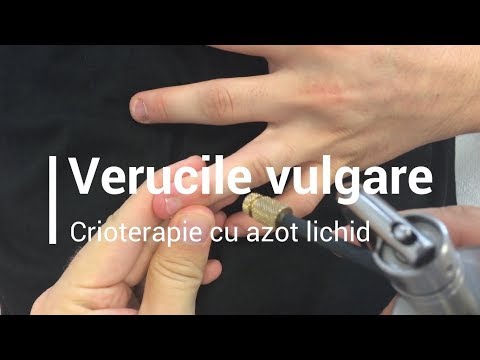 îndepărtarea reapariției verucilor genitale anemie usoara macrocitara