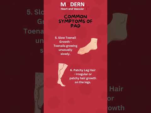 Common and Advanced Symptoms of PAD