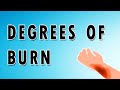 Burn Degrees: First, Second, and Third Degree Burns