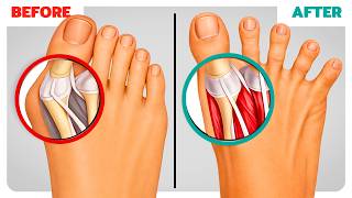 How to Build Feet So Strong You Never Get Bunions Again