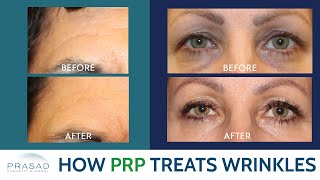 Effectiveness of PRP for Wrinkles #wrinkles