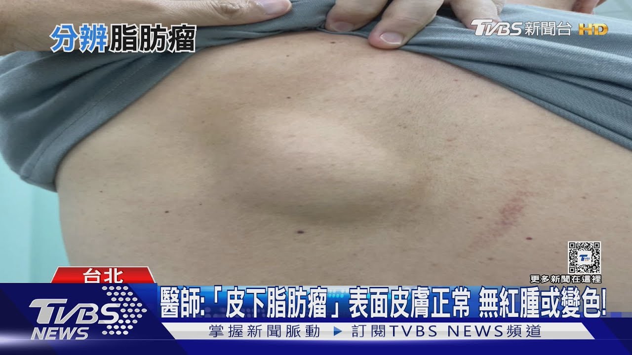 摸起來接近圓形不痛無紅腫 「腫瘤」長在身體「這幾處」醫師:速就醫檢查判定