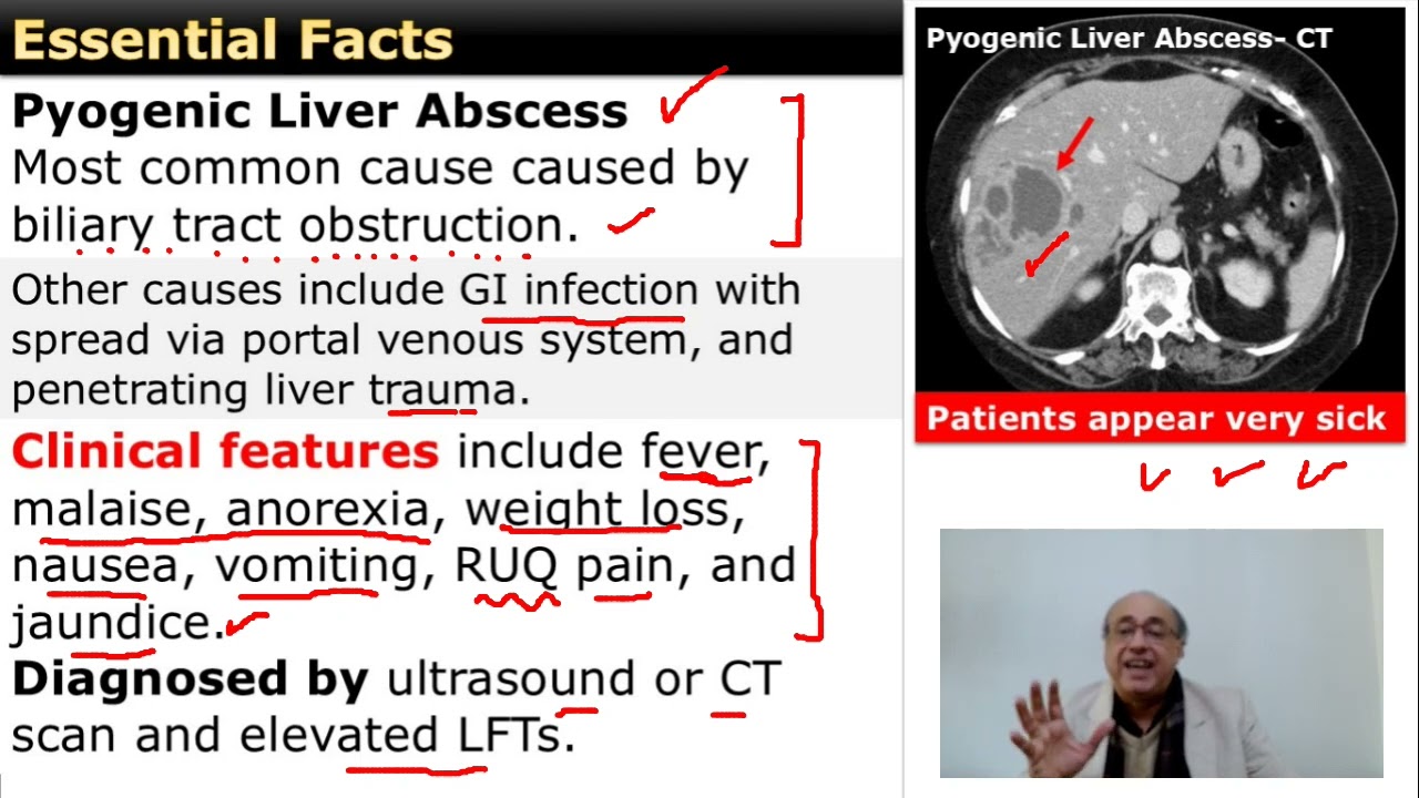 Pyogenic Liver Abscess