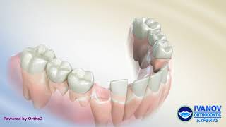 Space Maintaining Appliance for Children