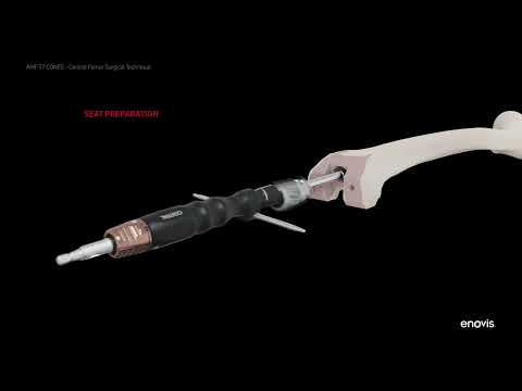 AMF TT Cones - Virtual Surgical Technique