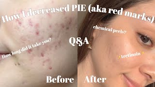 Tretinoin Q&A | How I lightened the PIE (aka red marks) on my cheeks