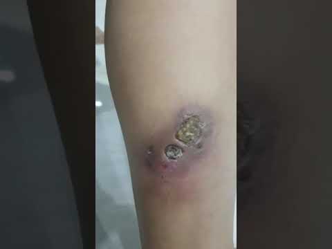 Côn Trùng Độc Các Loại Cắn Đốt