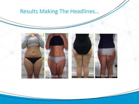 3D- lipo Before & After Results.