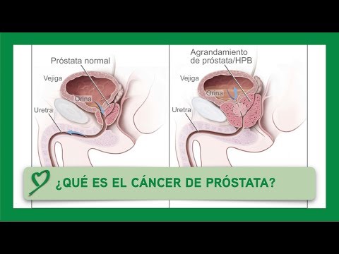 Die für chronische Prostatitis ist schädlich Kostengünstige und effektive Medikamente aus Prostatitis