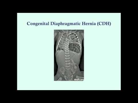 Newborn Gastrointestinal Disorders (Part 2) - CRASH! Medical Review Series