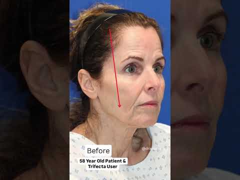 58 Year Old LOOKS 20 YEARS YOUNGER! Facelift Before & After!
