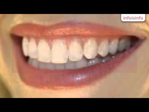 implantes dentales en Neiva - Implantes y Coronas I&C International - InfoIsInfo