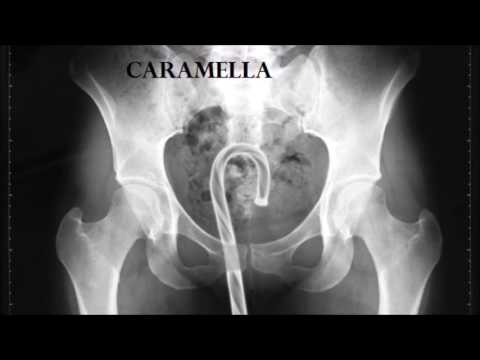 Rimuovere le pietre della prostata Rimozione del laser di adenomi prostatici spunti