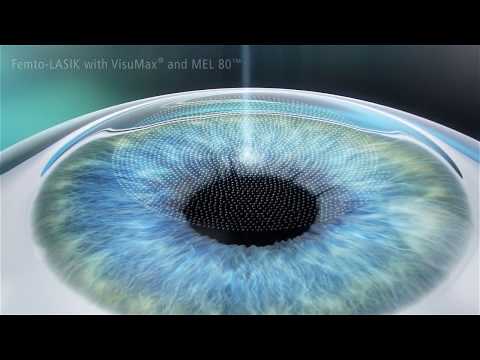 Technique chirurgie FEMTO LASIK