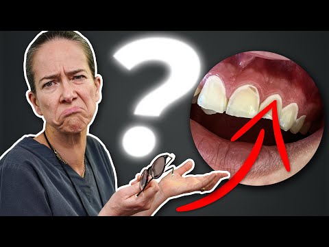 Schockierende Wahrheit über weiße Flecken auf Zähnen enthüllt...