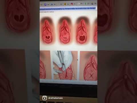 Tipos de Membrana Himenal | Dra. Thalia Maia | Grupo Elas | #shorts