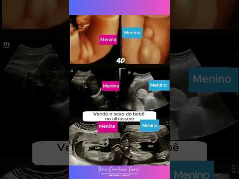 Consegue identificar o sexo do bebê no ultrassom?