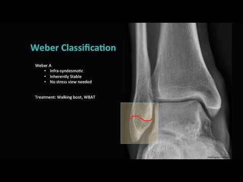 Distal Fibula Fractures