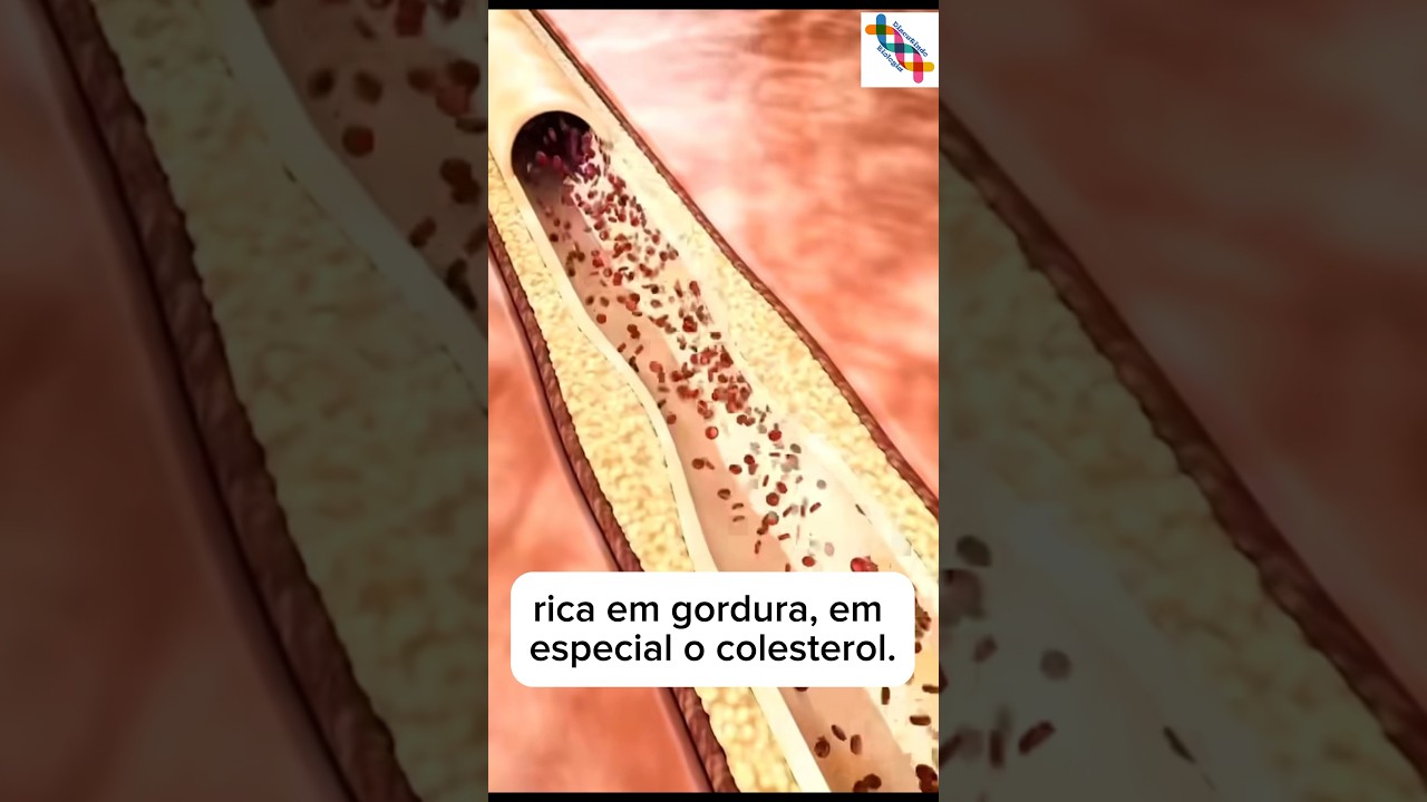 Infarto do miocárdio e o uso do Stent. #biologia #curiosidades #shortvideo #shorts #short #shots