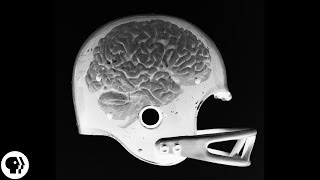 Are Concussions Deadly?