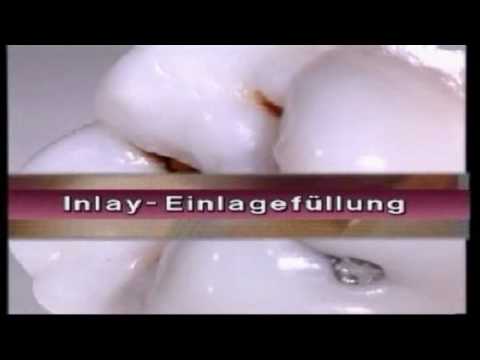 Amalgam - Die Alternativen. Video