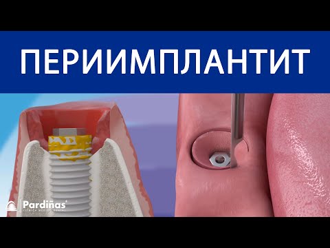 периимплантит ©