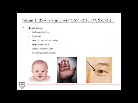 Aneuploidies: Trisomy 13, 18, 21, Turner Syndrome, Klinefelter Syndrome [Genetics 6 of 8]