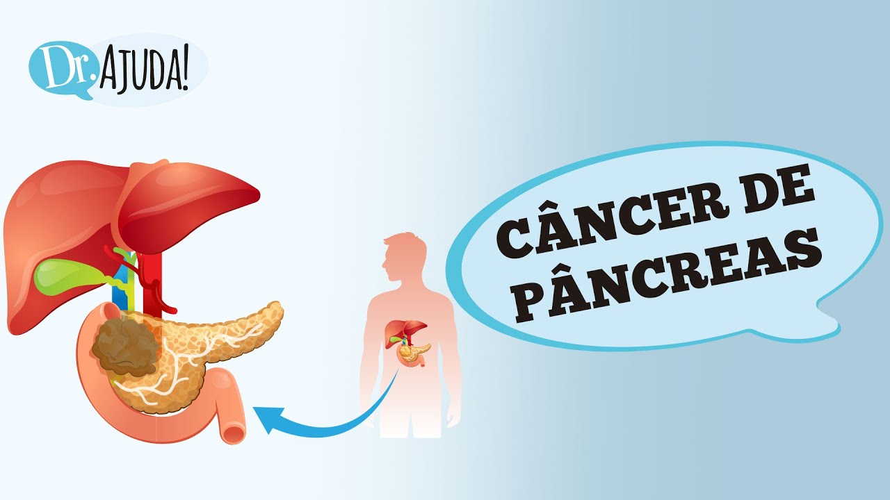 CÂNCER DE PÂNCREAS: QUAIS SÃO OS SINTOMAS? QUEM TEM MAIOR RISCO? O QUE FAZER?