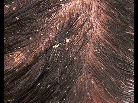 Soda sa paggamot ng fungal paa Kung paano ituring ang isang pumutok sa kuko ng hinlalaki sa paa
