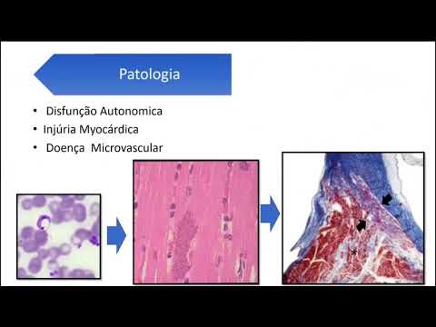 ASE Multimodality Cardiac Imaging in Patients with Chagas Disease Guideline Webinar