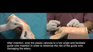 Radial puncture